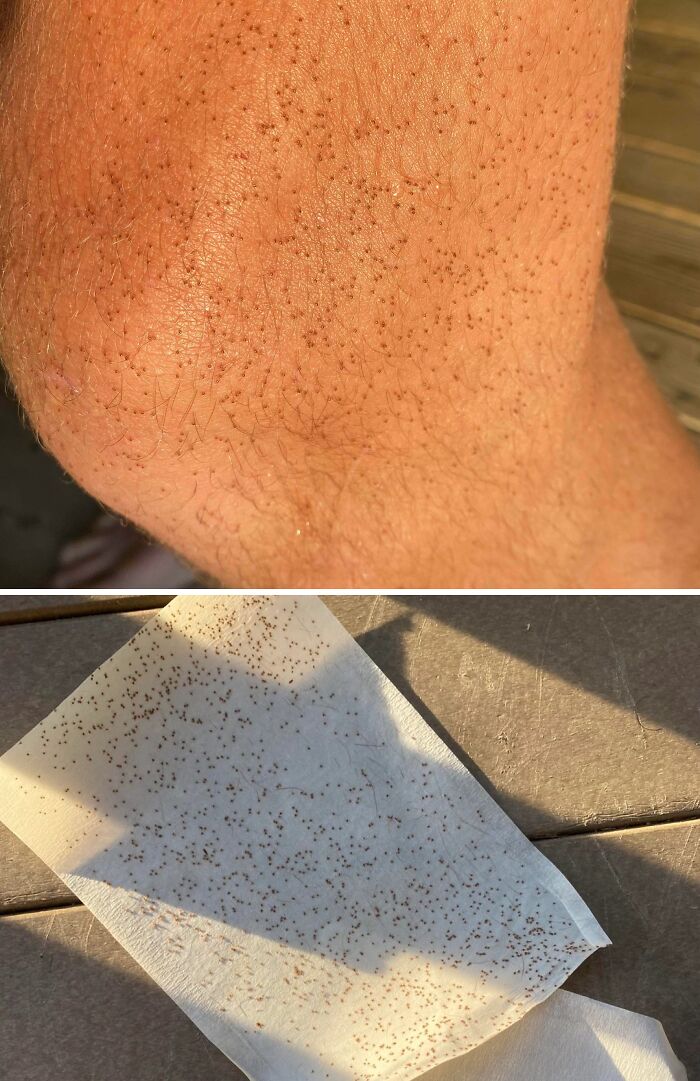 After A Walk, I Freaked Out Finding Ticks All Over Me. Stay Safe!