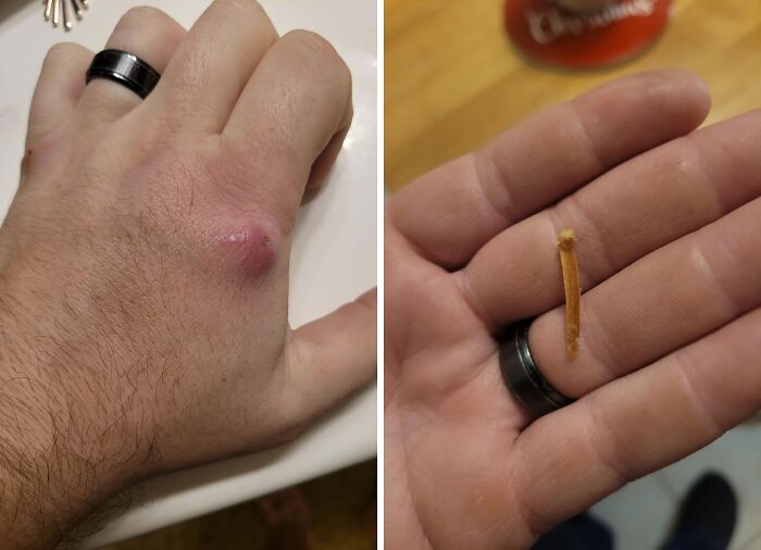 Thought I Broke My Knuckle For 2.5 Years, Last Night A Splinter Finally Popped Out