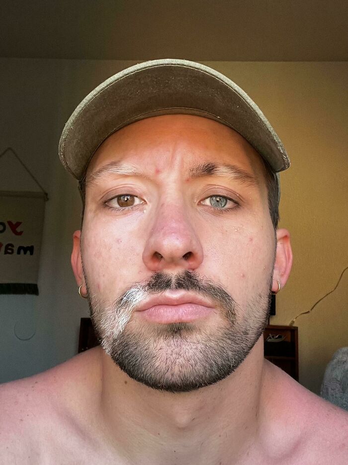 Vitiligo & Different Colored Eyes? Double Wow!