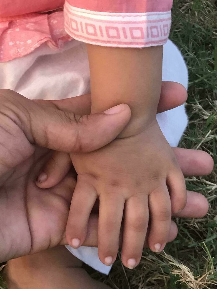 My Niece Rocks 6 Fingers On Both Hands. Yep, SIX!