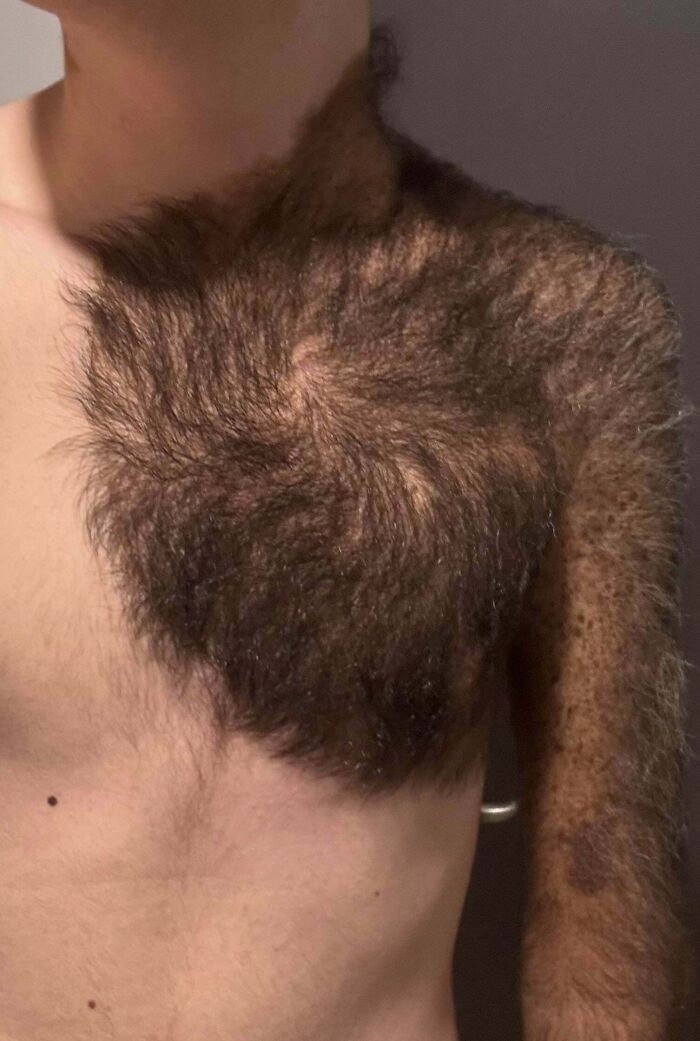 Giant Birthmark Alert! Born With A Congenital Nevus