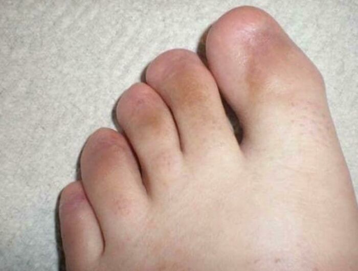 Footwear Challenge: Feet Without Toenails