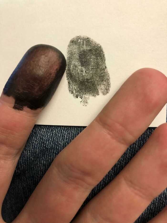 Born Without Finger or Toe Prints? That’s A Plot Twist!