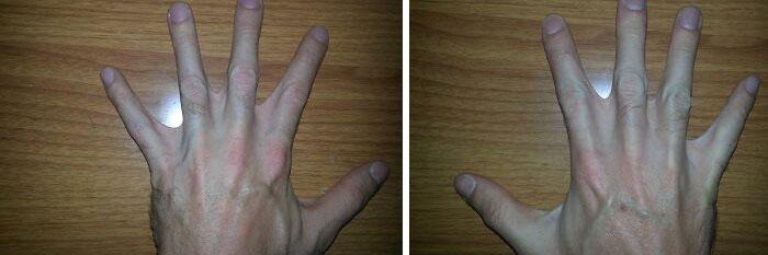 Webbed Fingers? Hold My Hand… Actually Both Hands!