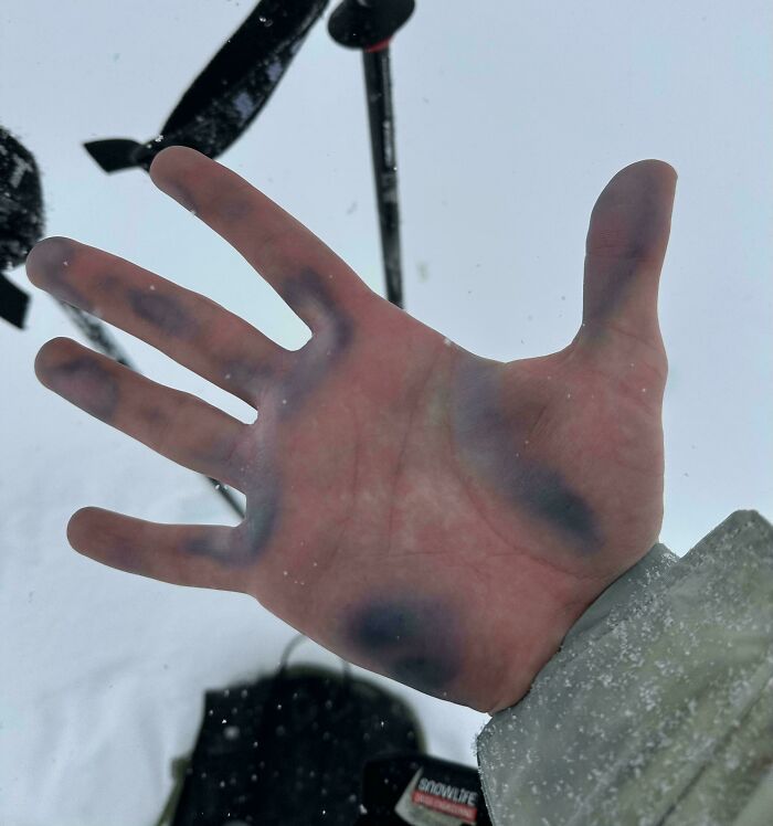 Hands After Cold Hangout (Thanks Thoracic Outlet Syndrome)