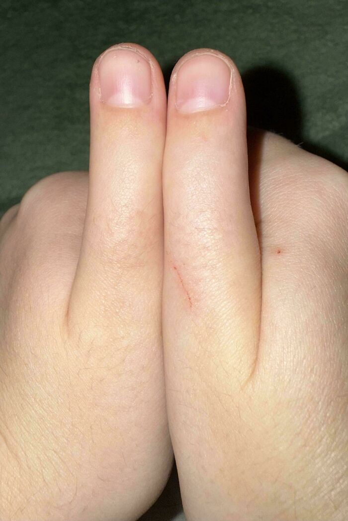Can’t Bend My Thumbs Thanks To A Wild Birth Defect