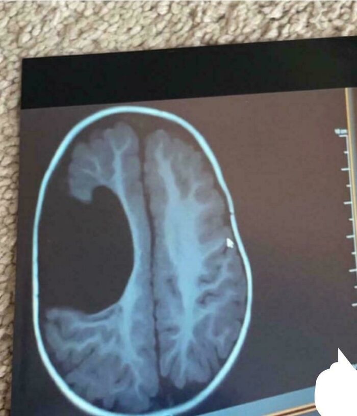 MRI Pic Of My Brain – Yup, This Is Real!