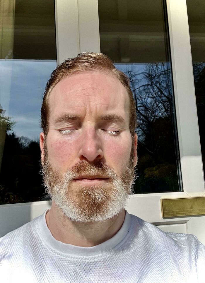 Vitiligo Turned My Eyelashes And Beard White, Fancy!