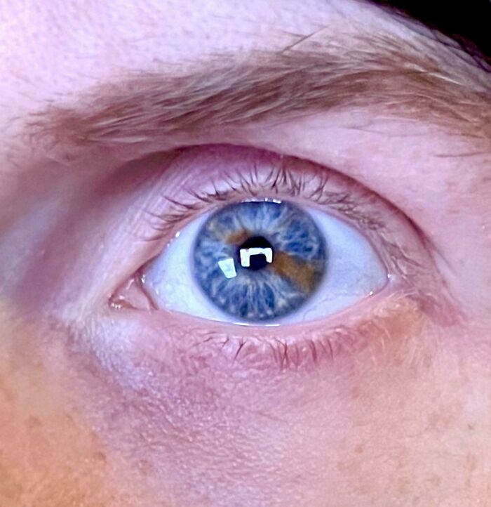 My Left Eye Is Like A Two-Tone Masterpiece