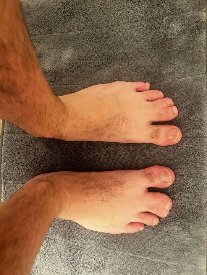 Webbed Toes? I Hid Mine For 40 Years. Time To Show ‘Em!
