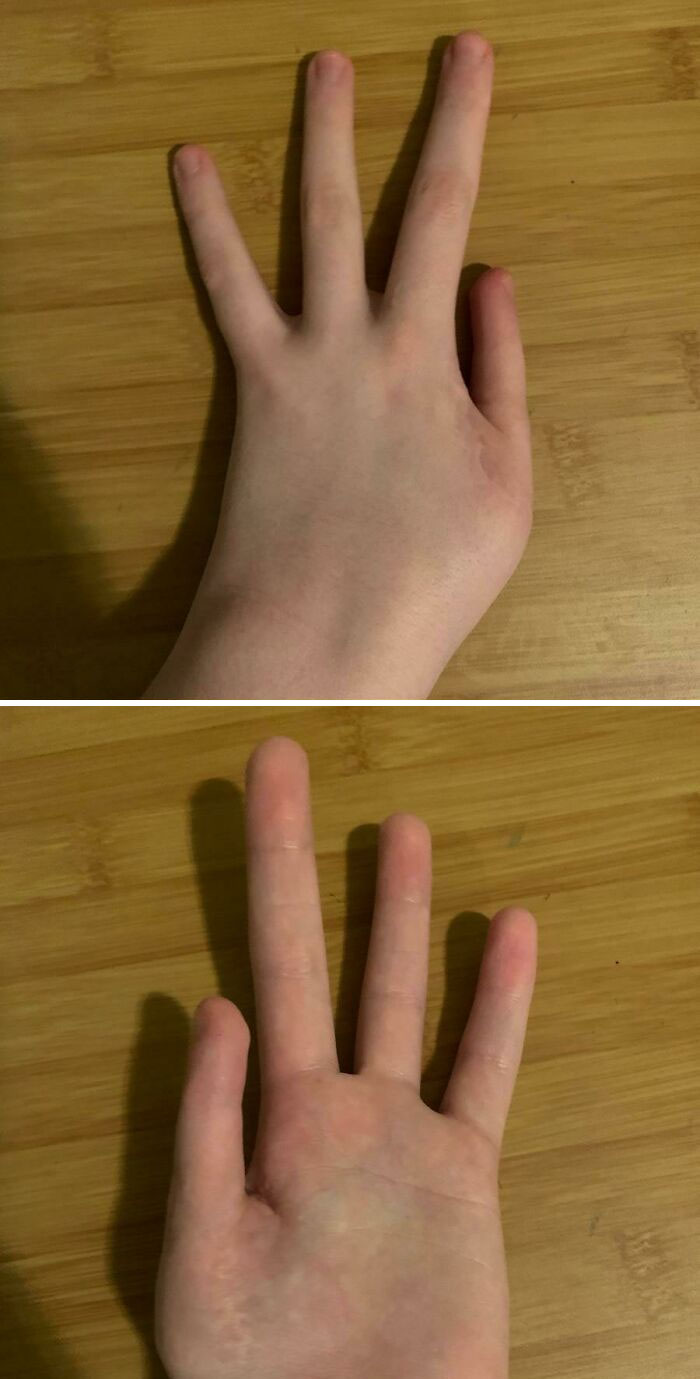 Left Hand Missing A Finger That Became My Thumb? Wild!