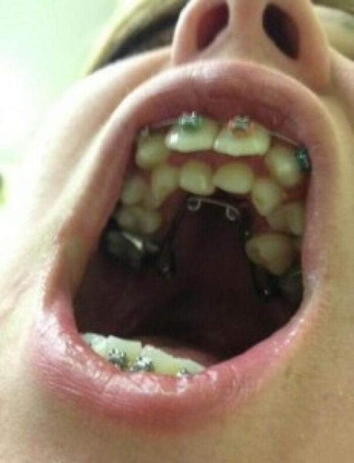 Say Hello To Hyperdontia: Extra Teeth Party!
