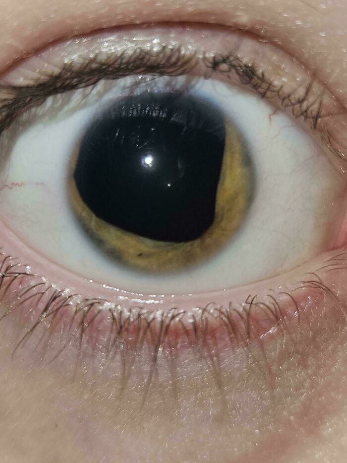 Almost No Eye Color? That’s A Thing Too!