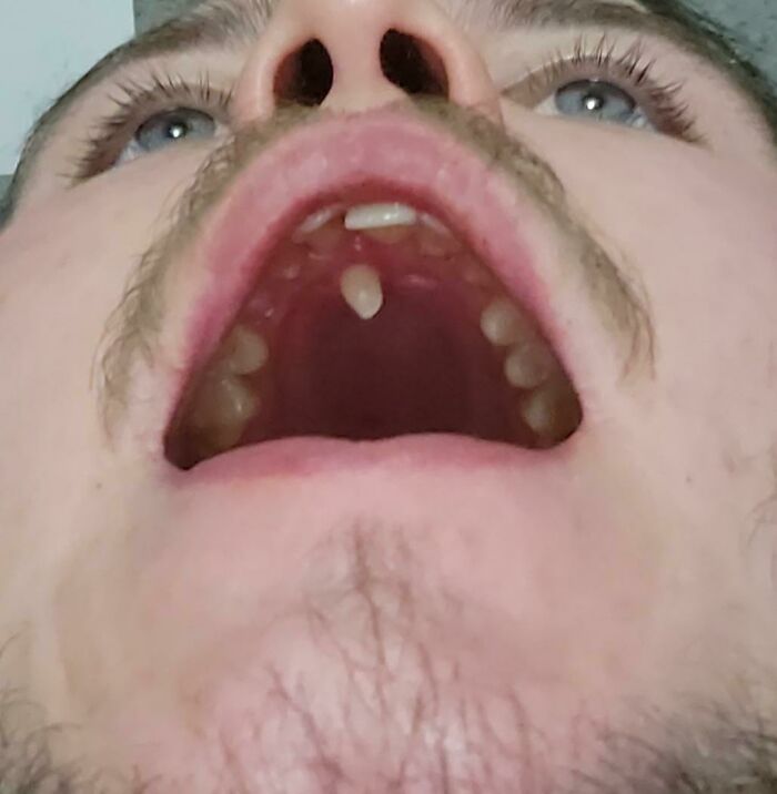 Extra Tooth, Roof Of The Mouth VIP!