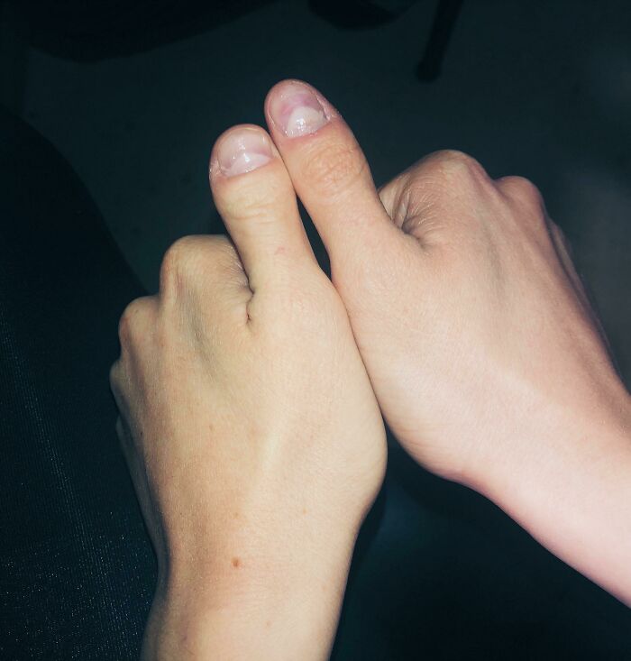 Got Thumbs From Both Parents Thanks To A Weird Mutation