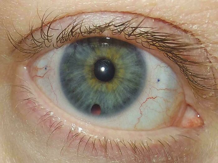 After Surgery Eye Looked Like A UFO Landed On My Iris