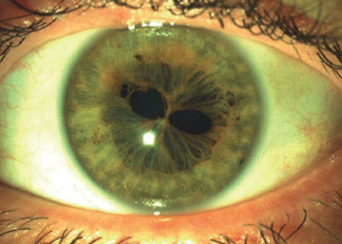 Human Eye With Multiple Pupils? Yep, It’s Real!