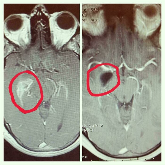 Brain Before and After Surgery: Science Wins!