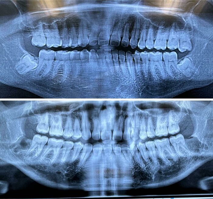 Wisdom Teeth Extraction: Before and After One Week
