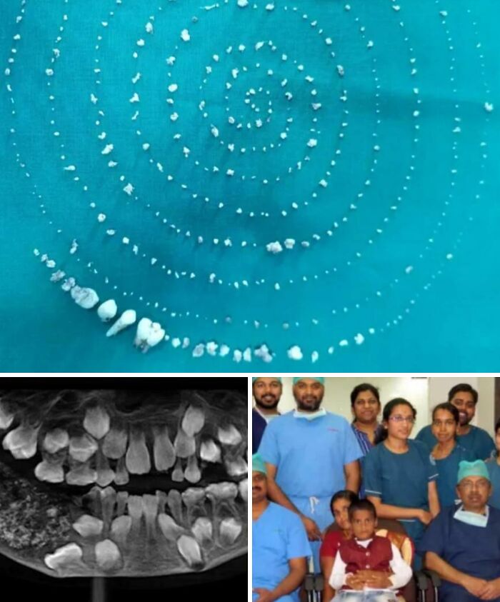 Boy in India Found with 526 Teeth in His Jaw—Yep, You Read That Right