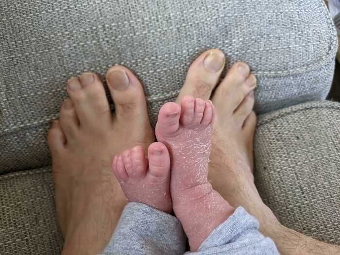 Joined Toes? My Son Got ‘Em Too!