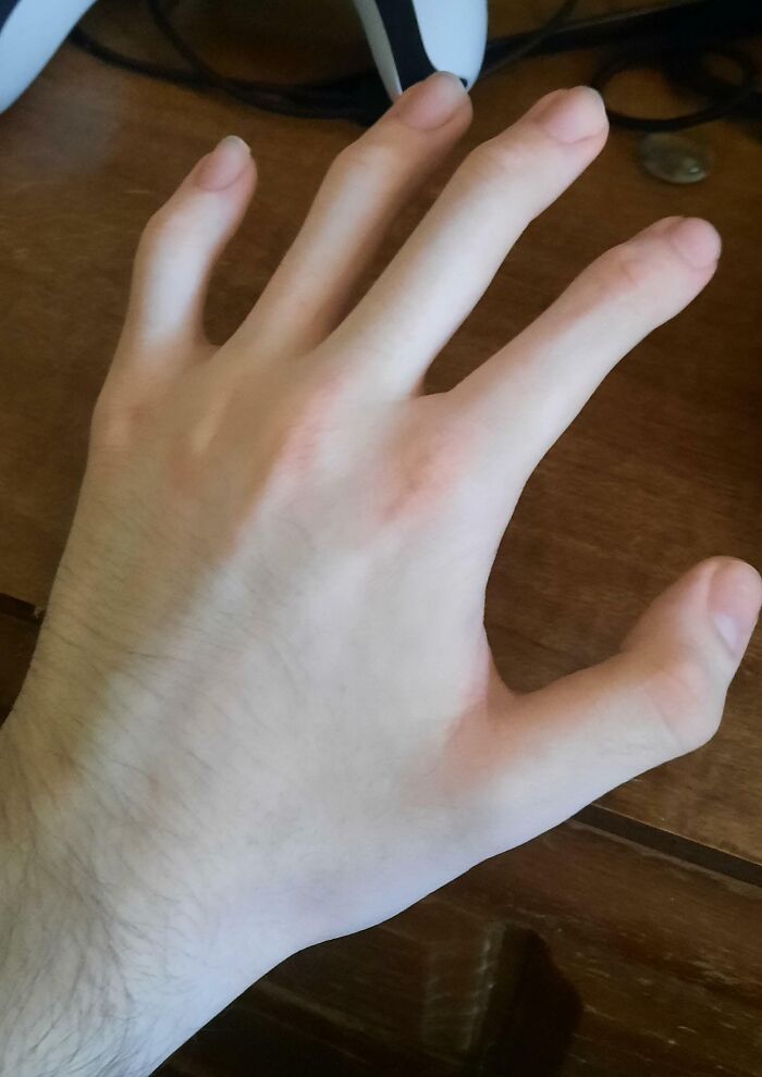 No Middle Knuckles on My Fingers or Toes—Hereditary Awesomeness
