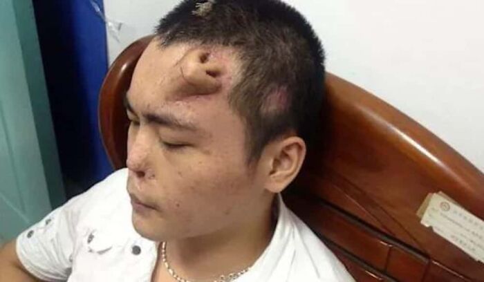Guy Grows a Nose on His Forehead Because Science Is Wild