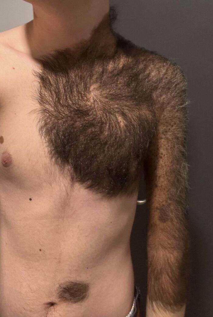 Born With a Giant Congenital Nevus? Own It Like a Boss