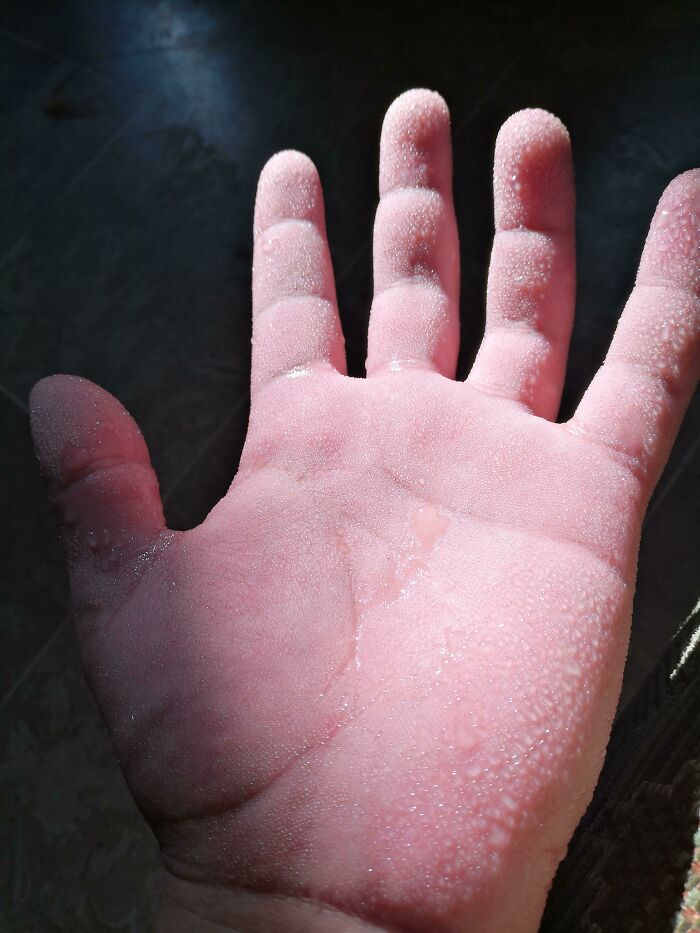 Sweaty Sunshine? I’ve Got Hyperhidrosis and These Are My Moist Hands