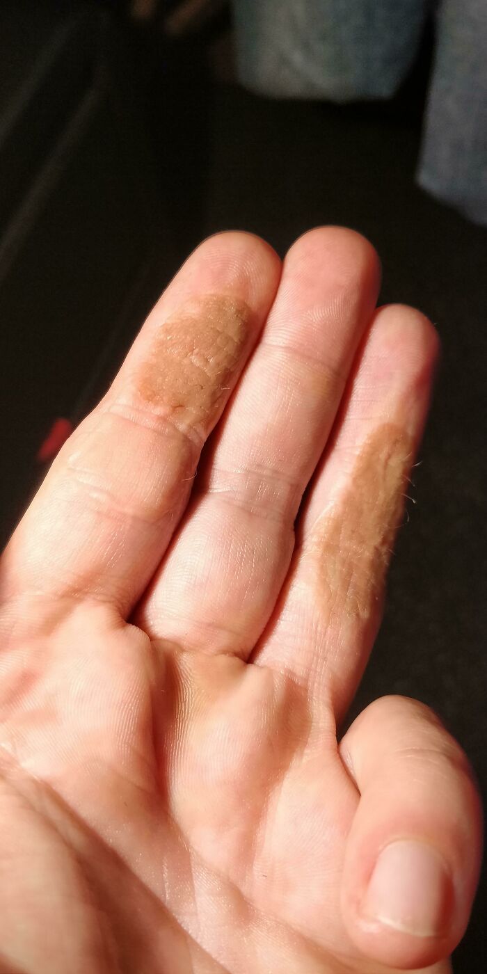 Hair Growing on My Fingers After a Skin Graft? Yep, That’s Me!