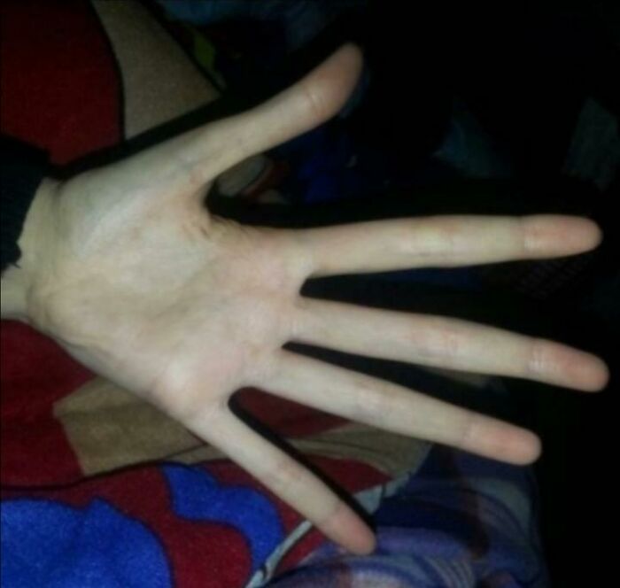 Marfan's Syndrome Hands Doing Their Thing