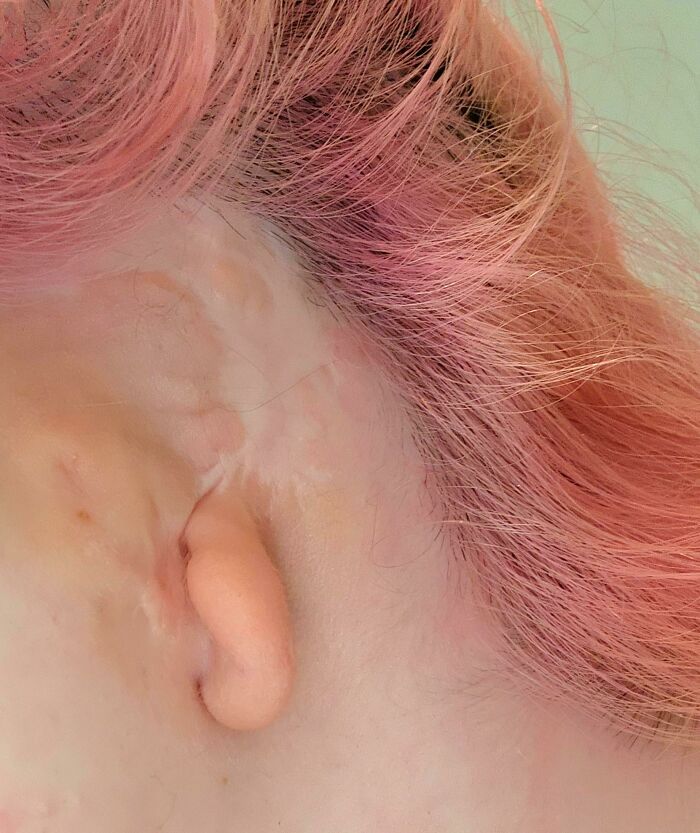 Born Without the Rest of My Ear — Unique and Proud