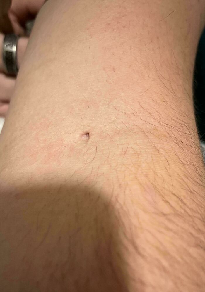 My Husband’s Plasma Donations Left Him with a Permanent Hole in His Arm — That's Dedication