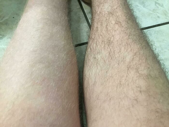 Left Leg Hair Blond, Right Leg Hair Black — Thanks, Pigmentation!